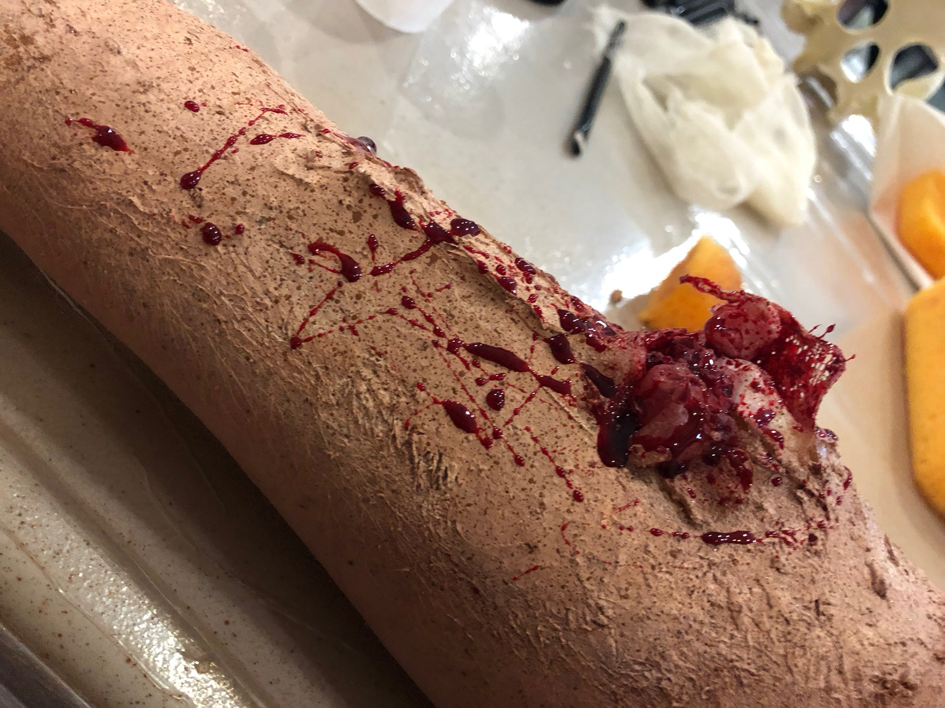 August 2018— Broken Bone