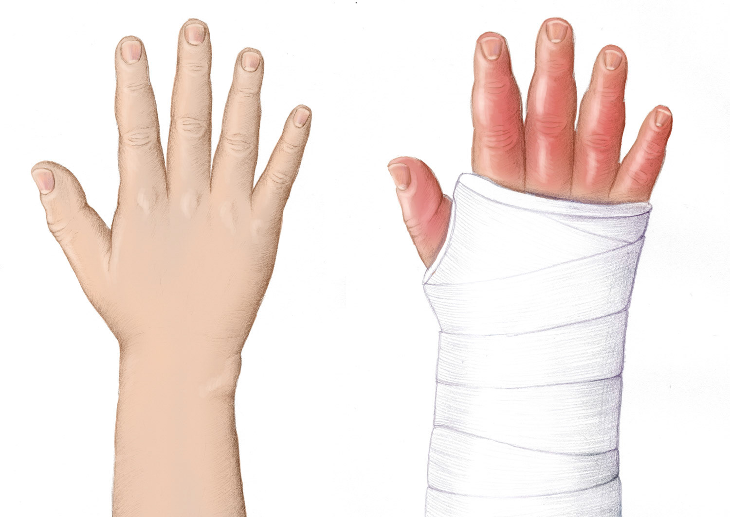 Emma Scheltema Illustration Cast Care Patient Education for Starship