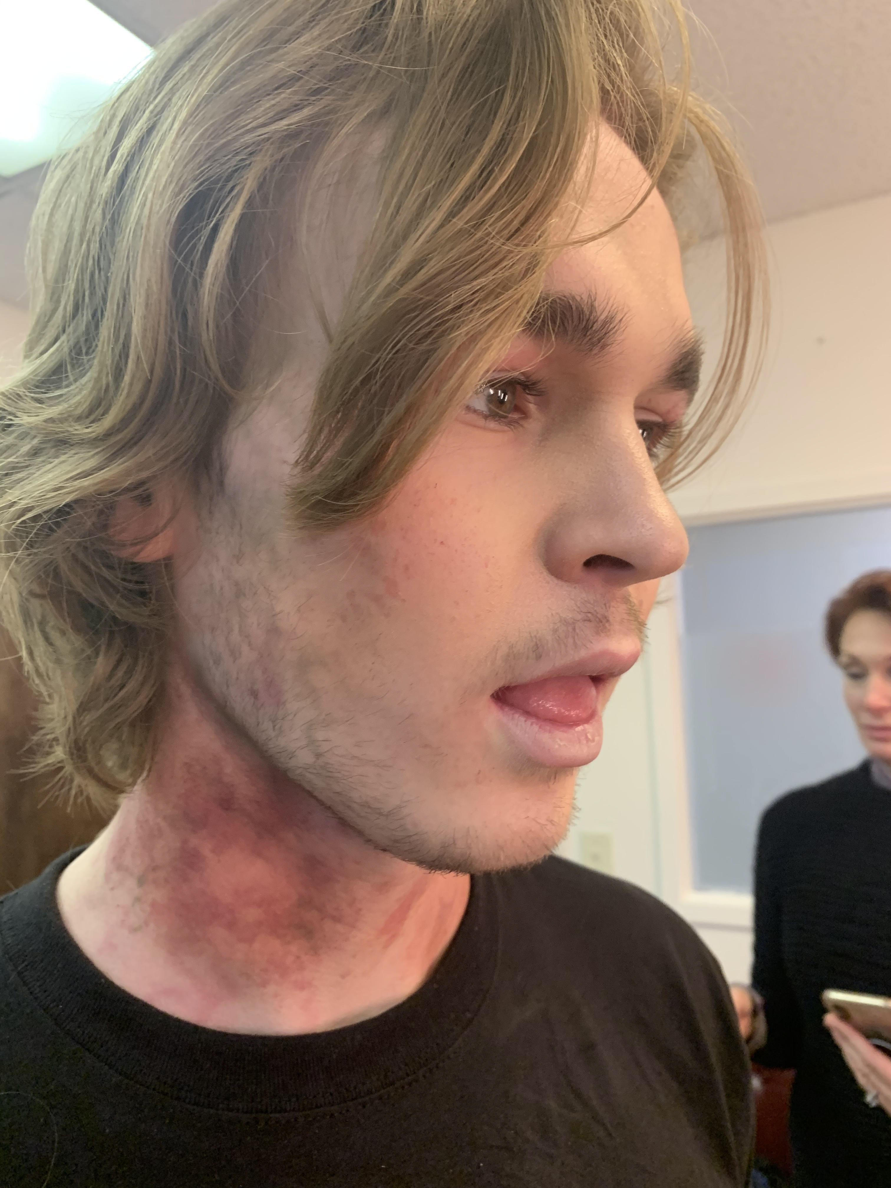 Bruising, dead