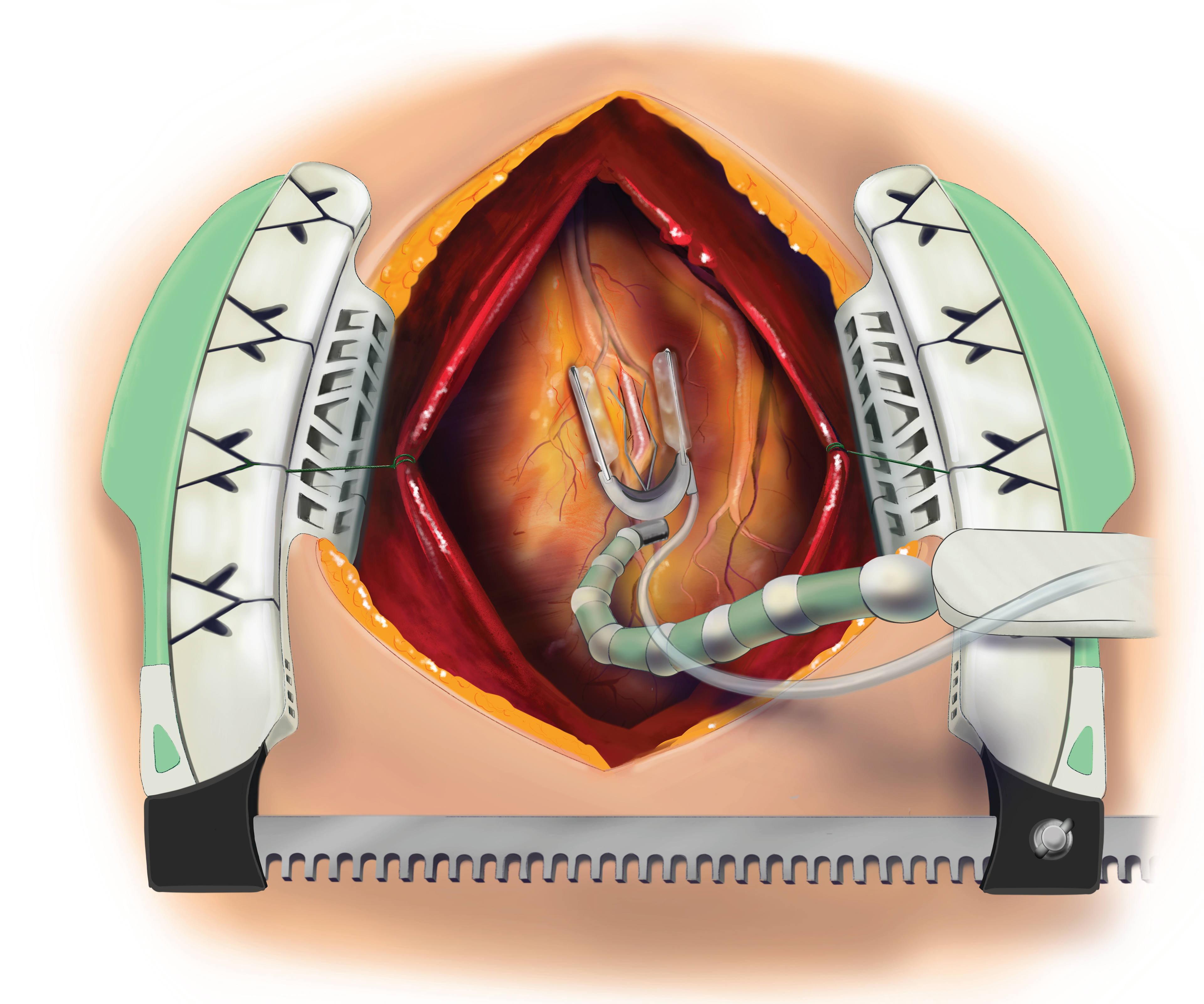 Off-pump Coronary Artery Bypass Graft (CABG)