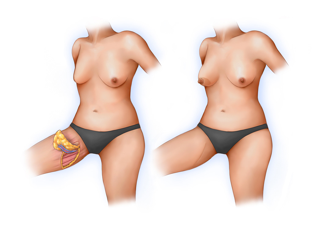 diagonal upper gracilis (DUG) flap for breast reconstruction patient education