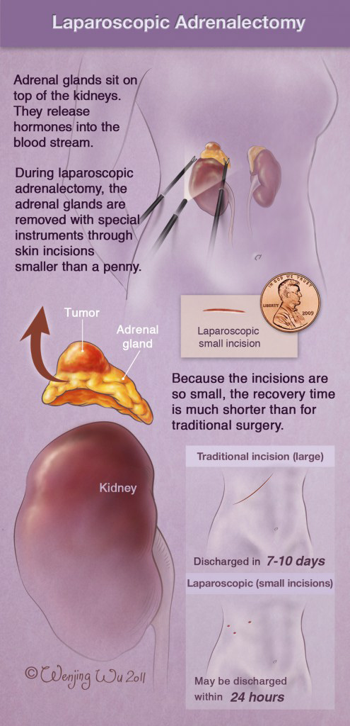 left adrenalectomy