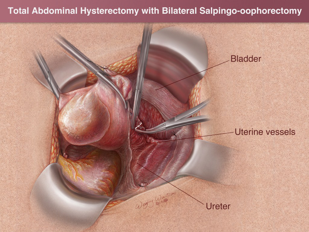 total abdominal hysterectomy